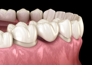 dental bridge