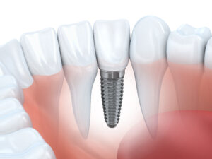 Tooth human implant (done in 3d graphics)