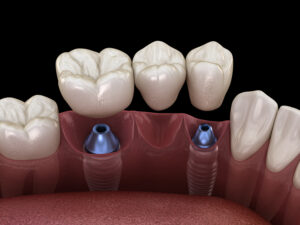 Dental bridge supported by implants. Medically accurate 3D illustration of human teeth and dentures concept