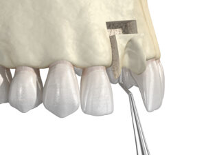 Bone grafting- augmentation using block of bone, tooth implantation. Medically accurate 3D illustration