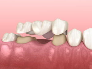 dental bridge