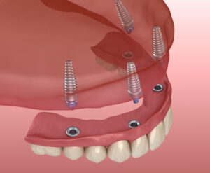 Implant Support NPB CA