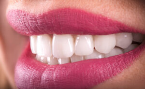 Veneers npb ca