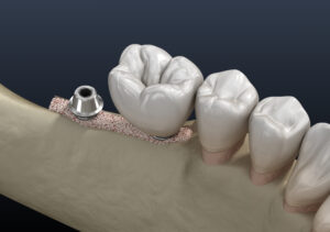 newport beach bone grafting