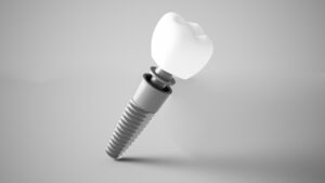 newport beach dental implants