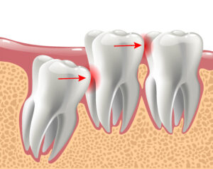 newport beach wisdom teeth