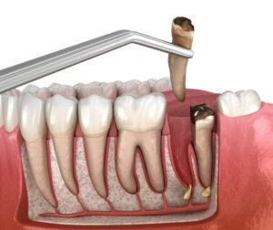 newport beach oral surgery