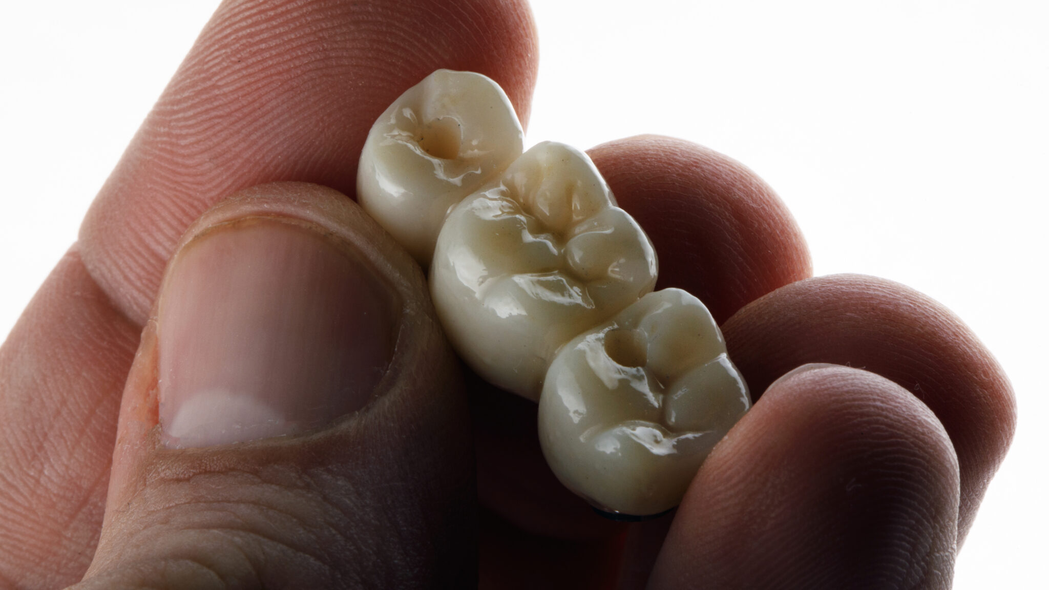 Dental Bridge Balboa Dental Surgery