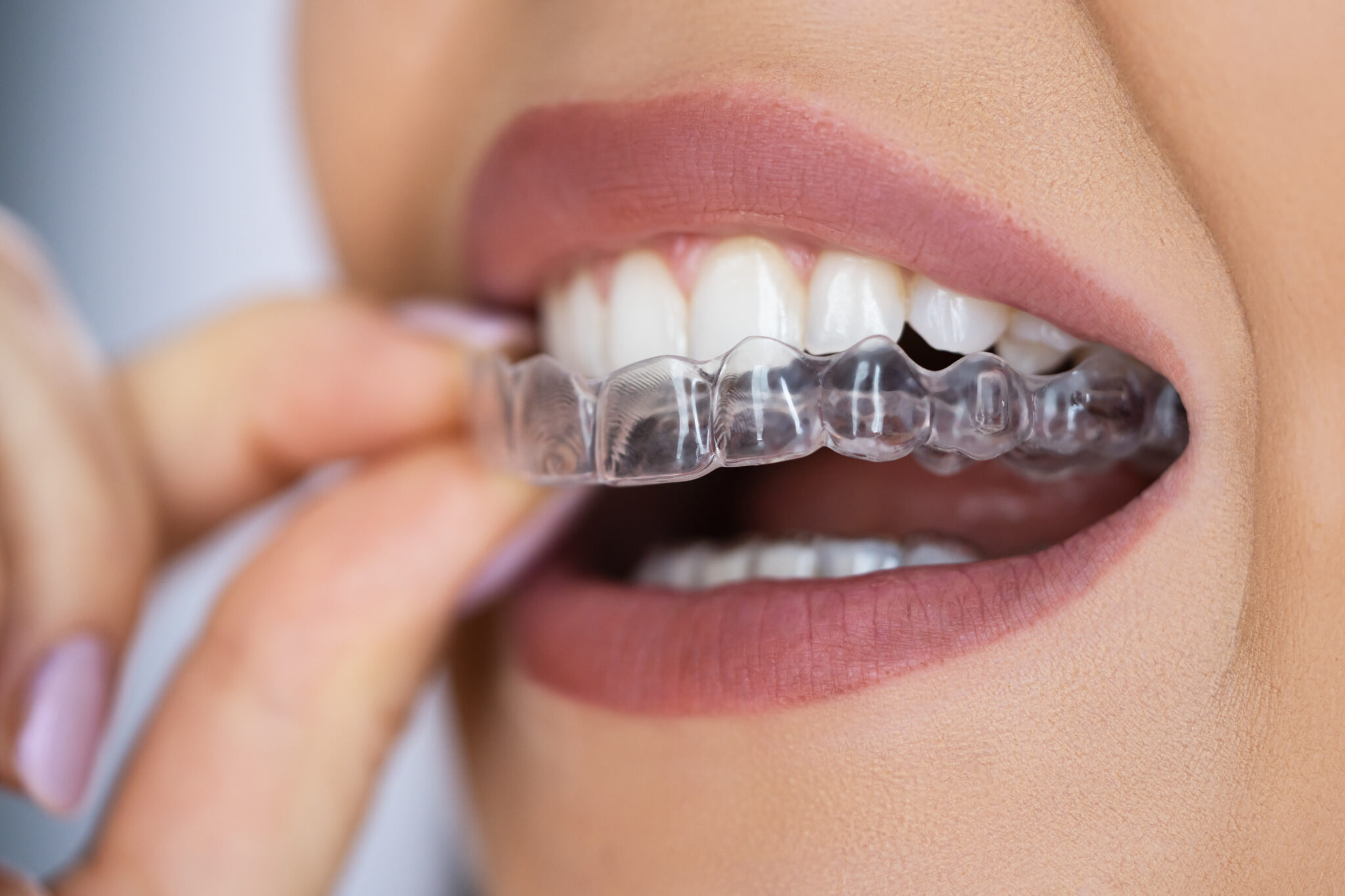 How Night Guards Prevent Bruxism Damage | Newport Beach, CA