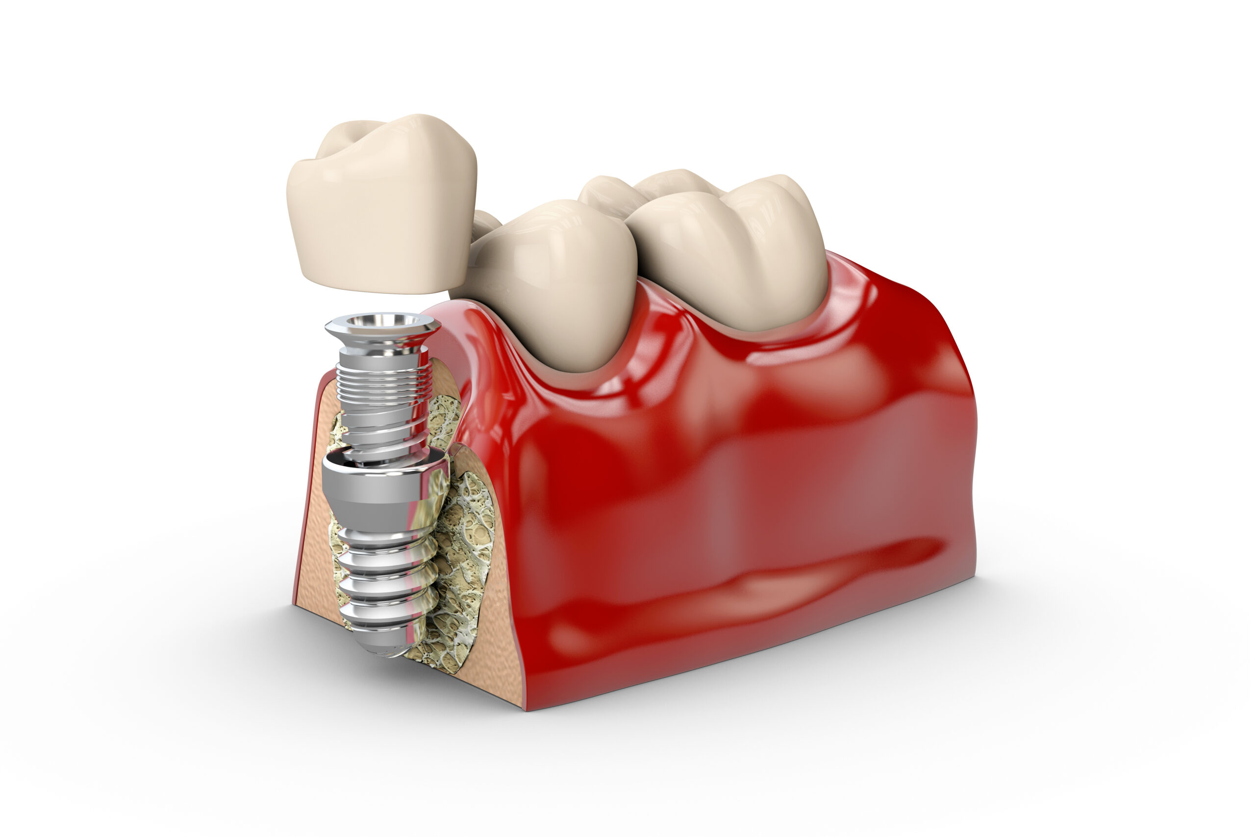 newport beach dental implants