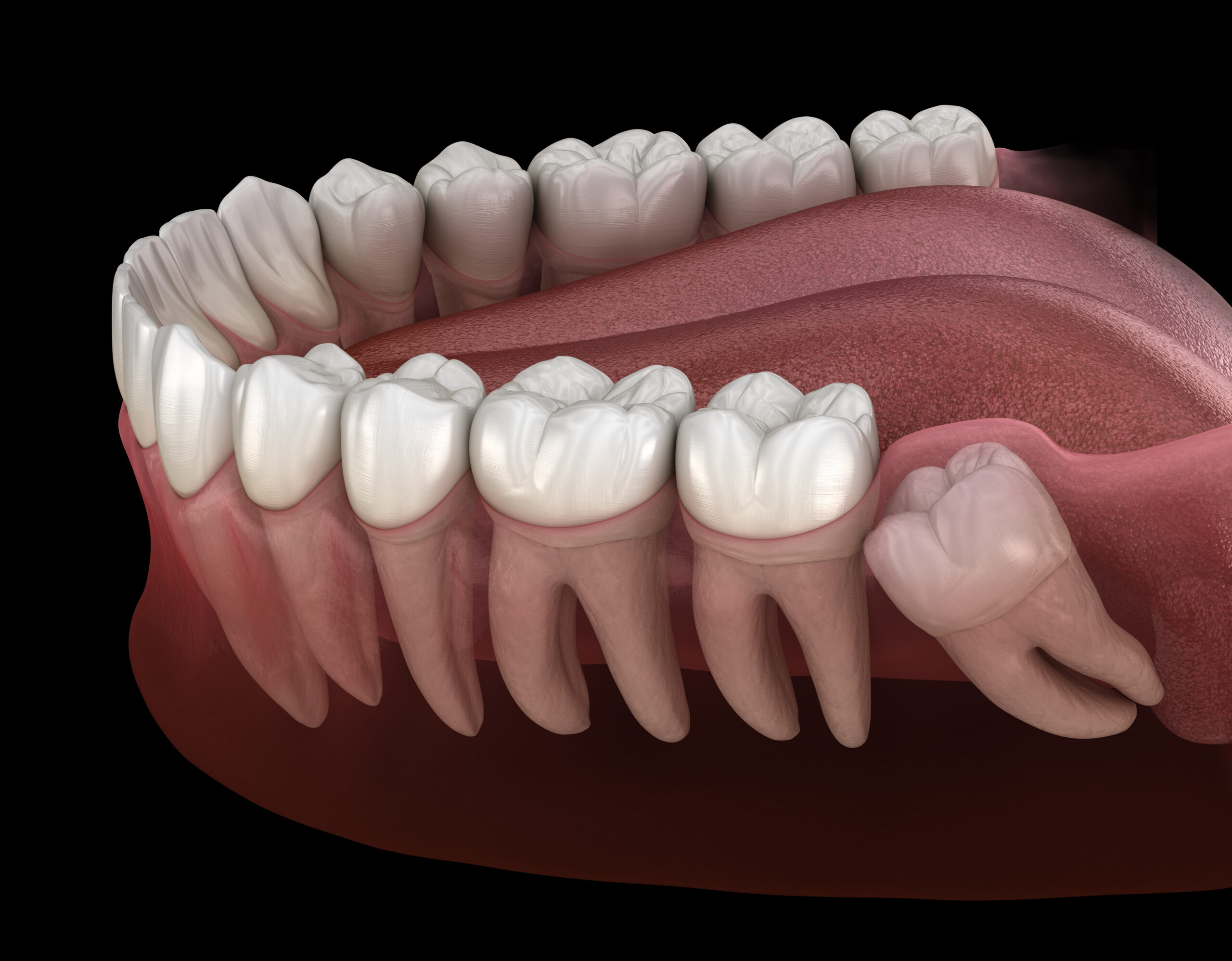 newport beach wisdom teeth