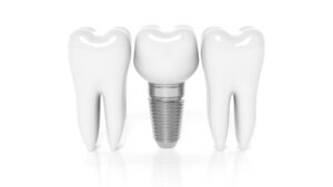 newport beach dental implants