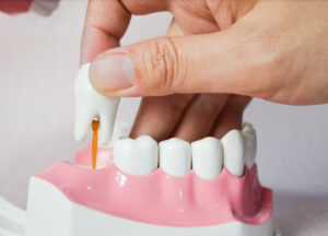 newport beach wisdom tooth extraction