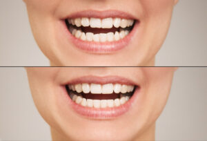 newport beach veneers