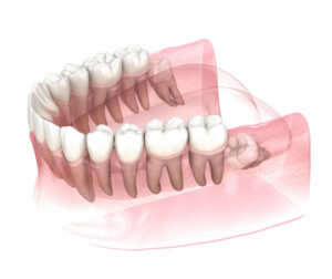 newport beach wisdom teeth