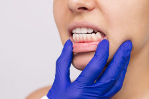 newport beach oral cancer screening